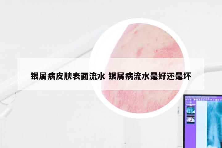 银屑病皮肤表面流水 银屑病流水是好还是坏