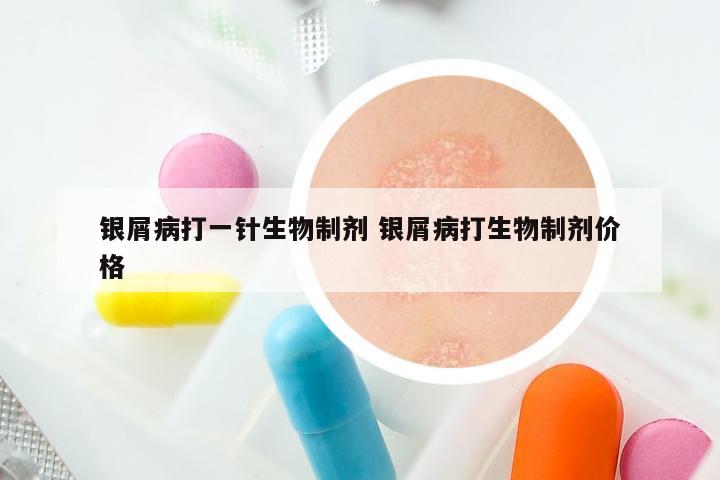 银屑病打一针生物制剂 银屑病打生物制剂价格