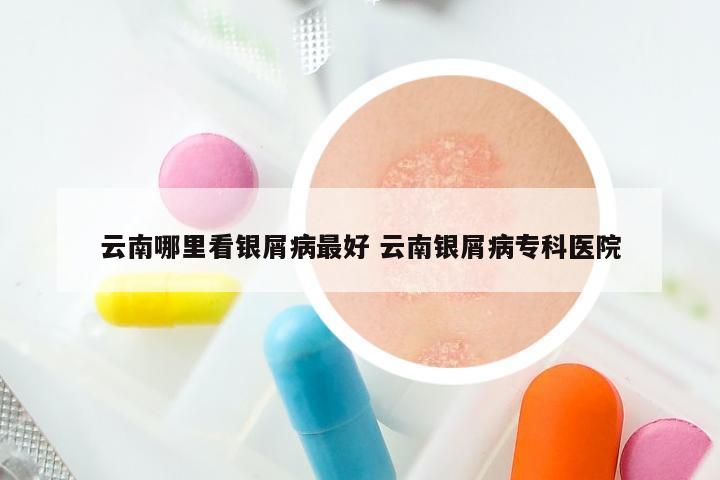 云南哪里看银屑病最好 云南银屑病专科医院
