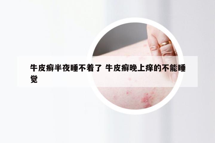 牛皮癣半夜睡不着了 牛皮癣晚上痒的不能睡觉