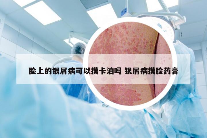 脸上的银屑病可以摸卡泊吗 银屑病摸脸药膏