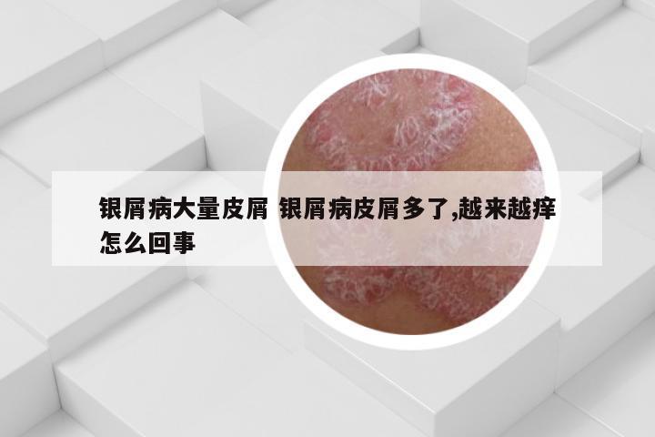 银屑病大量皮屑 银屑病皮屑多了,越来越痒怎么回事