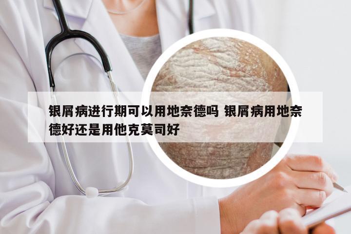 银屑病进行期可以用地奈德吗 银屑病用地奈德好还是用他克莫司好