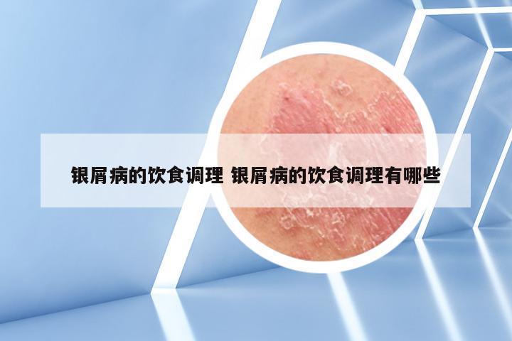 银屑病的饮食调理 银屑病的饮食调理有哪些