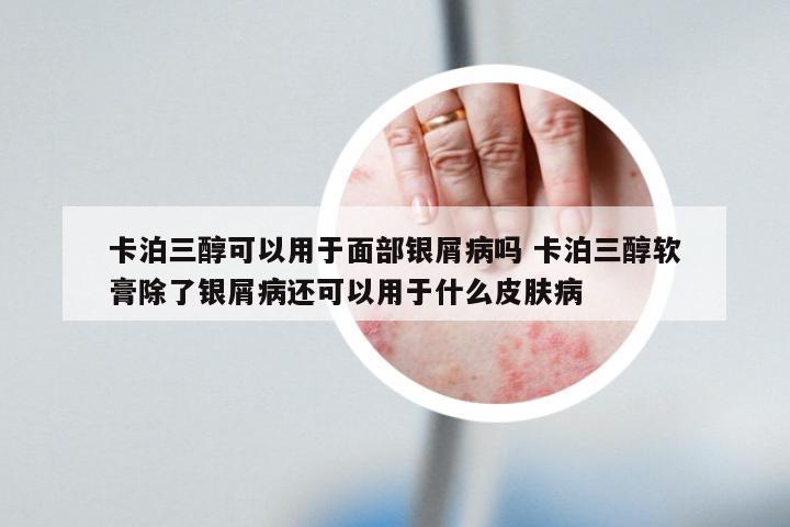 卡泊三醇可以用于面部银屑病吗 卡泊三醇软膏除了银屑病还可以用于什么皮肤病