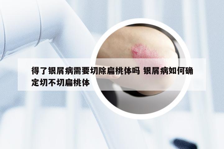 得了银屑病需要切除扁桃体吗 银屑病如何确定切不切扁桃体
