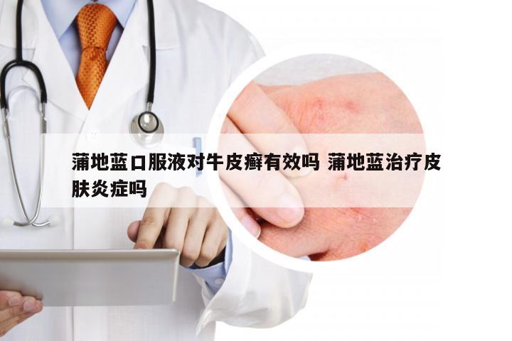 蒲地蓝口服液对牛皮癣有效吗 蒲地蓝治疗皮肤炎症吗