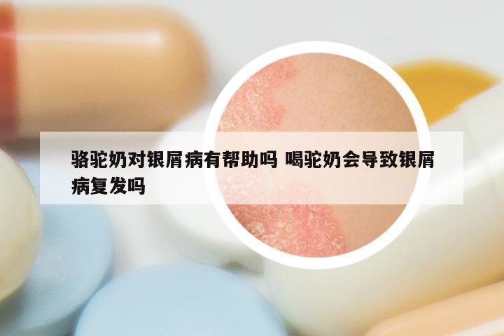 骆驼奶对银屑病有帮助吗 喝驼奶会导致银屑病复发吗