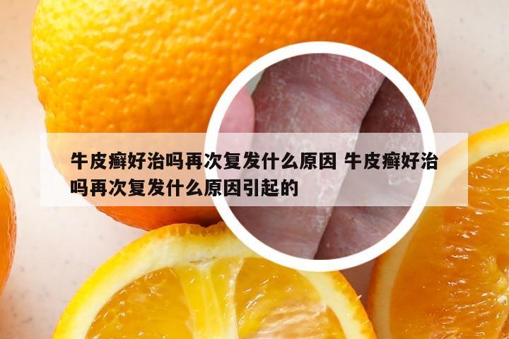 牛皮癣好治吗再次复发什么原因 牛皮癣好治吗再次复发什么原因引起的