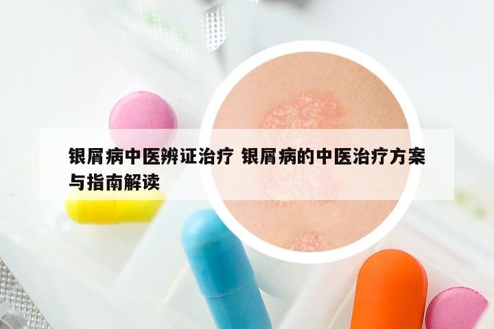 银屑病中医辨证治疗 银屑病的中医治疗方案与指南解读