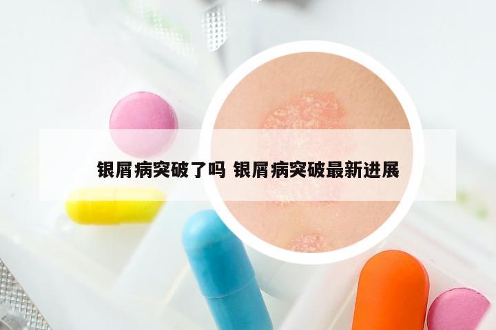 银屑病突破了吗 银屑病突破最新进展