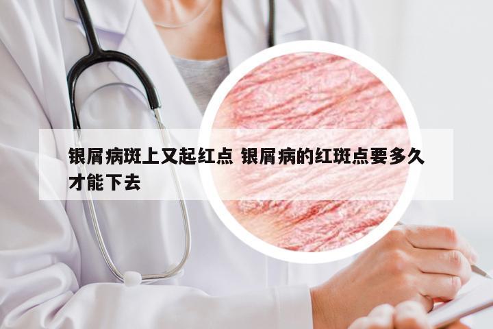 银屑病斑上又起红点 银屑病的红斑点要多久才能下去