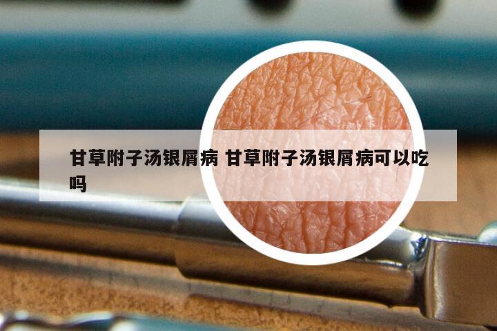 甘草附子汤银屑病 甘草附子汤银屑病可以吃吗