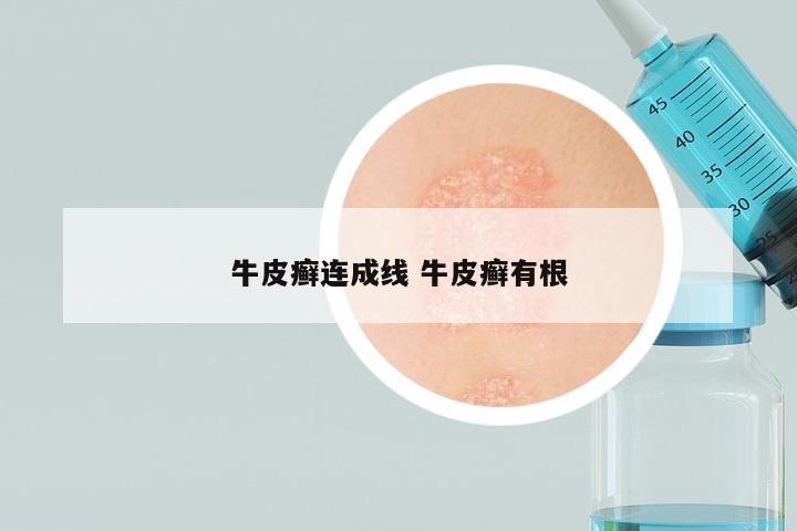 牛皮癣连成线 牛皮癣有根