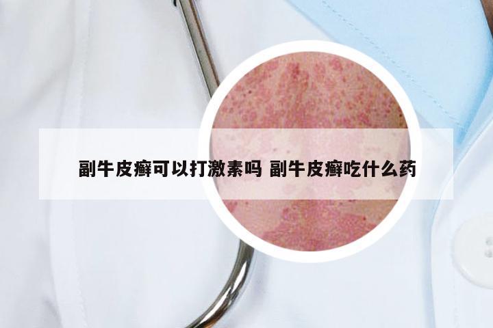 副牛皮癣可以打激素吗 副牛皮癣吃什么药