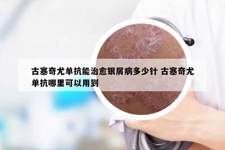 古塞奇尤单抗能治愈银屑病多少针 古塞奇尤单抗哪里可以用到