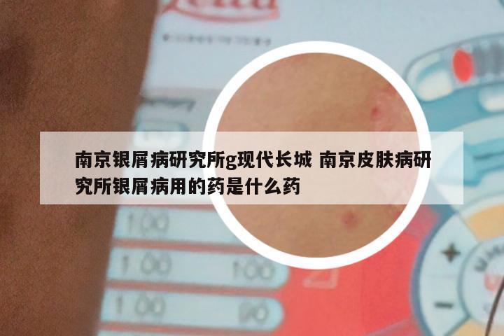 南京银屑病研究所g现代长城 南京皮肤病研究所银屑病用的药是什么药