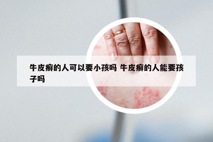 牛皮癣的人可以要小孩吗 牛皮癣的人能要孩子吗