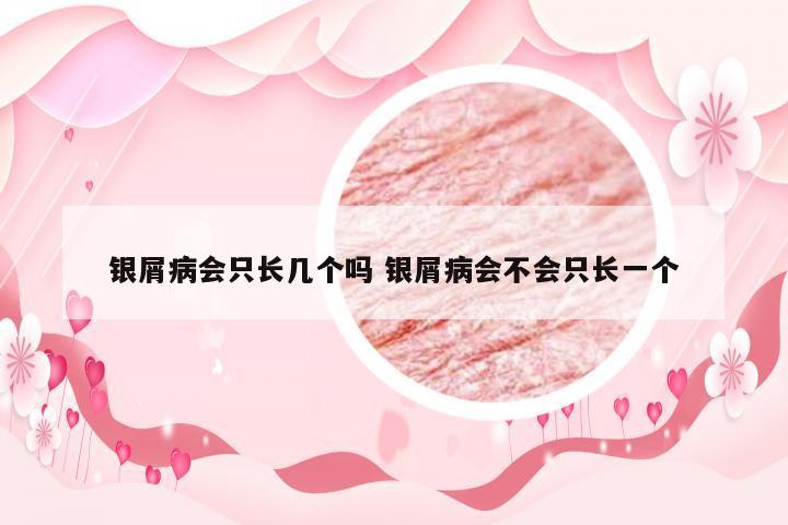 银屑病会只长几个吗 银屑病会不会只长一个