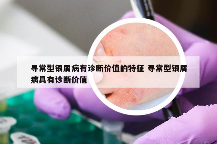 寻常型银屑病有诊断价值的特征 寻常型银屑病具有诊断价值