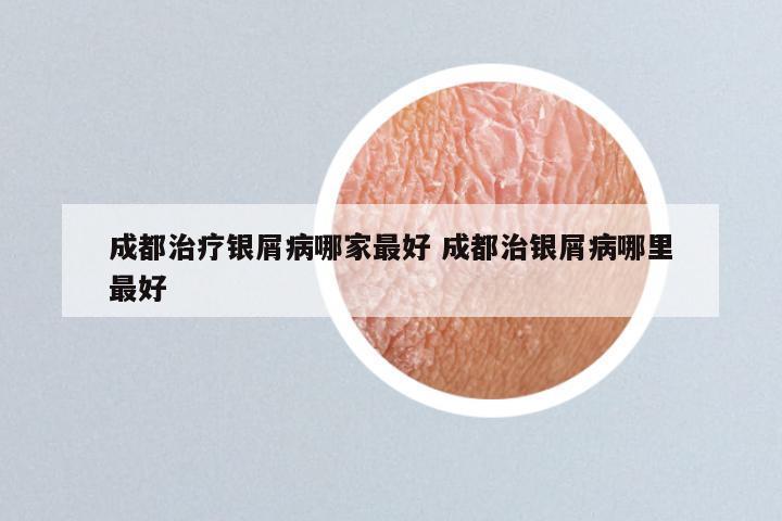 成都治疗银屑病哪家最好 成都治银屑病哪里最好