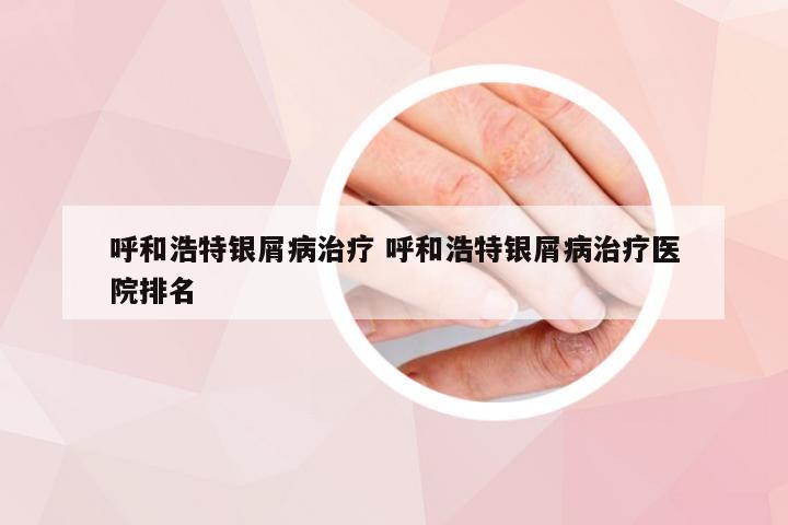 呼和浩特银屑病治疗 呼和浩特银屑病治疗医院排名