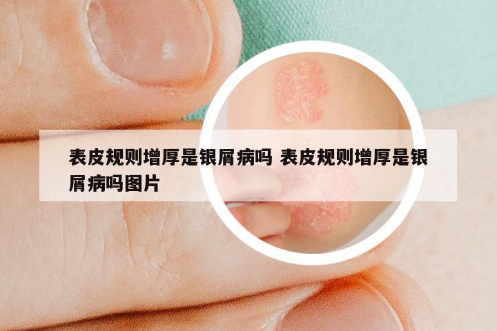 表皮规则增厚是银屑病吗 表皮规则增厚是银屑病吗图片