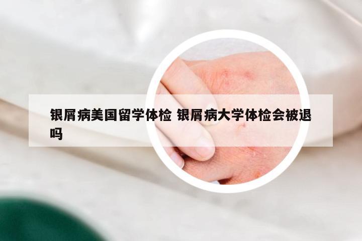 银屑病美国留学体检 银屑病大学体检会被退吗