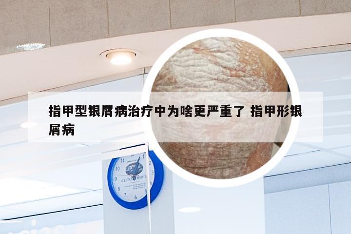 指甲型银屑病治疗中为啥更严重了 指甲形银屑病
