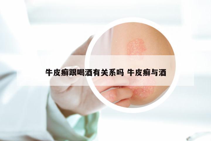 牛皮癣跟喝酒有关系吗 牛皮癣与酒
