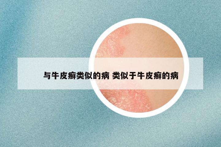与牛皮癣类似的病 类似于牛皮癣的病
