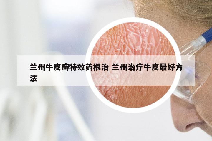 兰州牛皮癣特效药根治 兰州治疗牛皮最好方法