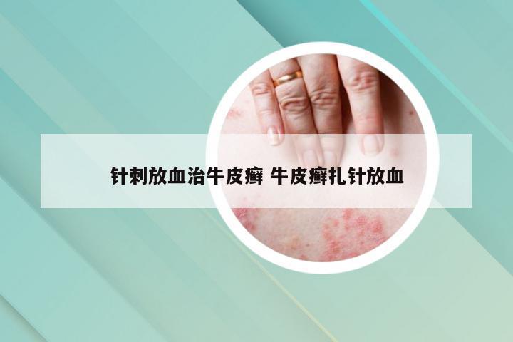 针刺放血治牛皮癣 牛皮癣扎针放血
