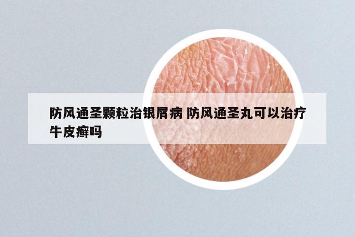 防风通圣颗粒治银屑病 防风通圣丸可以治疗牛皮癣吗