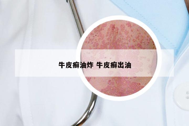 牛皮癣油炸 牛皮癣出油