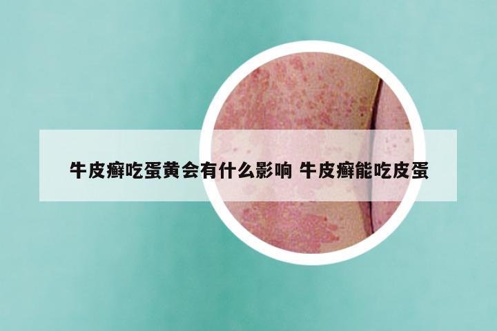 牛皮癣吃蛋黄会有什么影响 牛皮癣能吃皮蛋