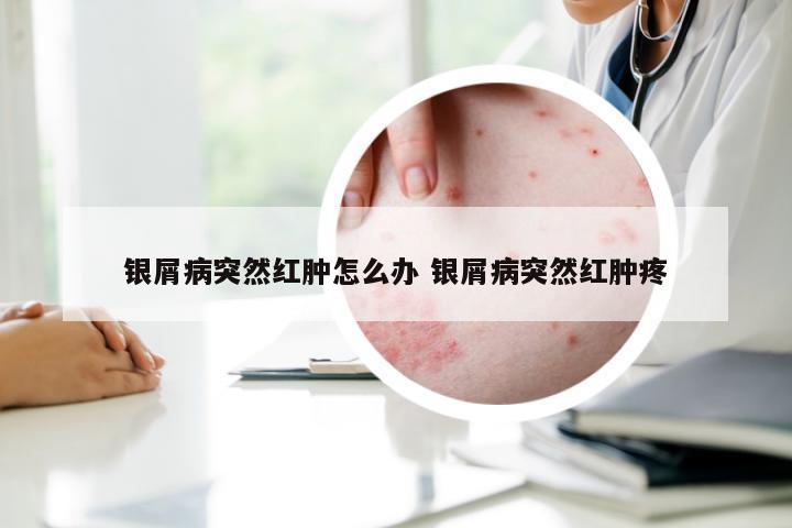 银屑病突然红肿怎么办 银屑病突然红肿疼