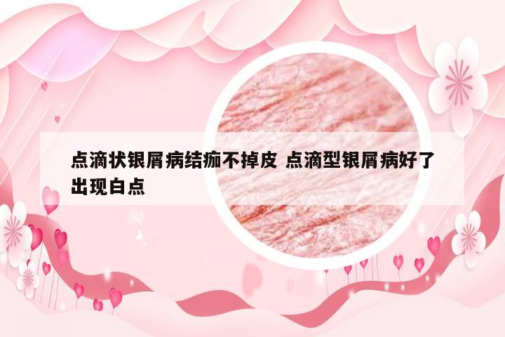 点滴状银屑病结痂不掉皮 点滴型银屑病好了出现白点