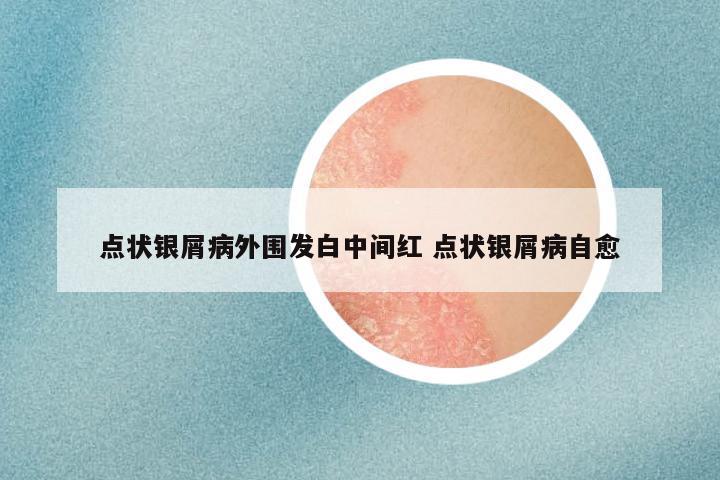 点状银屑病外围发白中间红 点状银屑病自愈