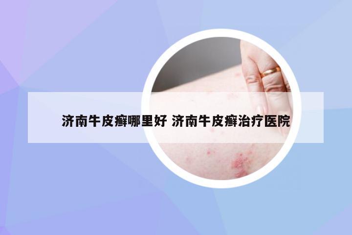 济南牛皮癣哪里好 济南牛皮癣治疗医院