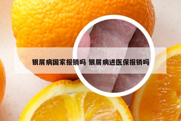 银屑病国家报销吗 银屑病进医保报销吗