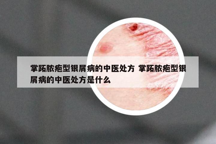 掌跖脓疱型银屑病的中医处方 掌跖脓疱型银屑病的中医处方是什么