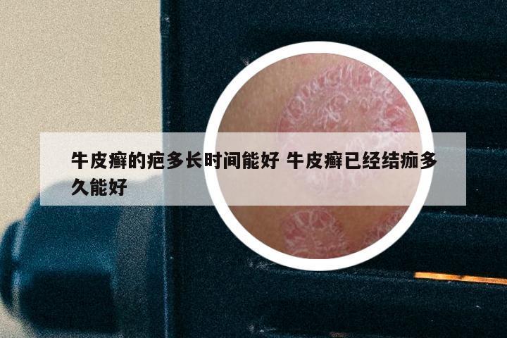 牛皮癣的疤多长时间能好 牛皮癣已经结痂多久能好