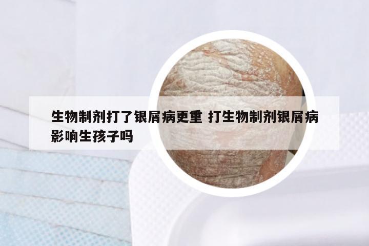 生物制剂打了银屑病更重 打生物制剂银屑病影响生孩子吗