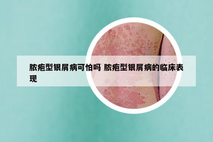 脓疱型银屑病可怕吗 脓疱型银屑病的临床表现