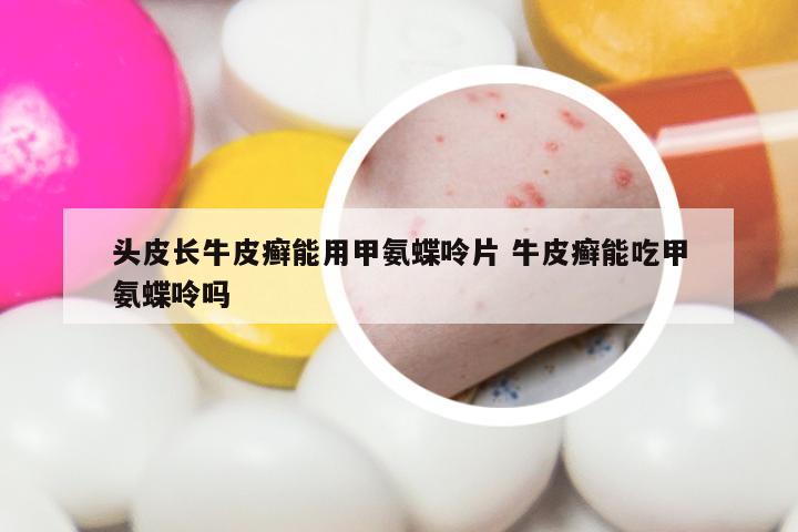 头皮长牛皮癣能用甲氨蝶呤片 牛皮癣能吃甲氨蝶呤吗