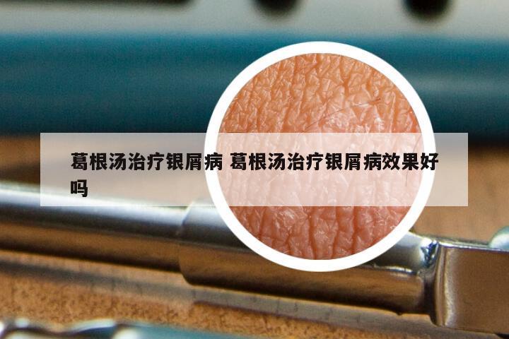 葛根汤治疗银屑病 葛根汤治疗银屑病效果好吗
