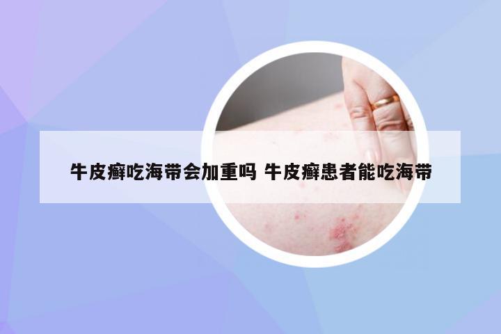 牛皮癣吃海带会加重吗 牛皮癣患者能吃海带