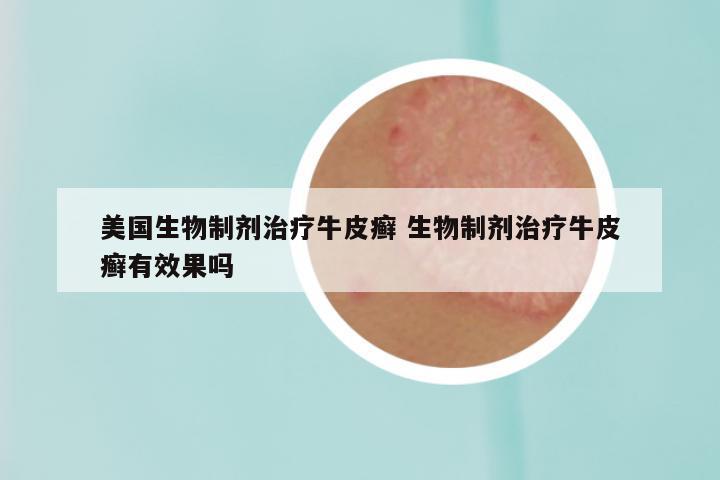 美国生物制剂治疗牛皮癣 生物制剂治疗牛皮癣有效果吗