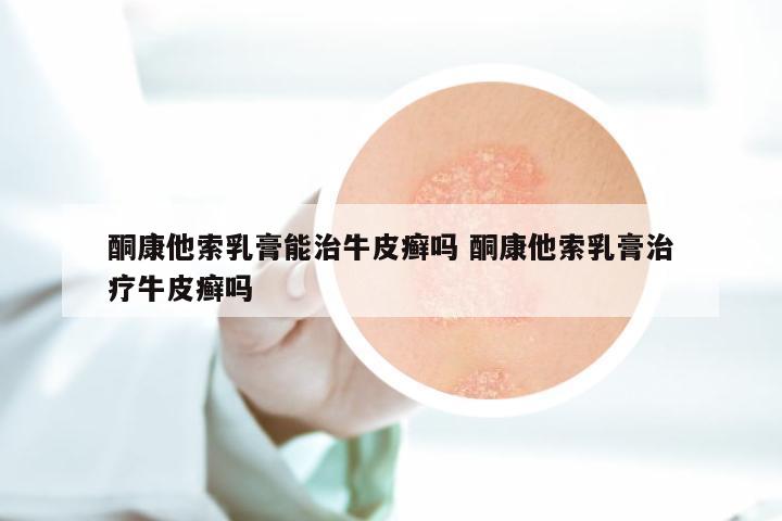 酮康他索乳膏能治牛皮癣吗 酮康他索乳膏治疗牛皮癣吗